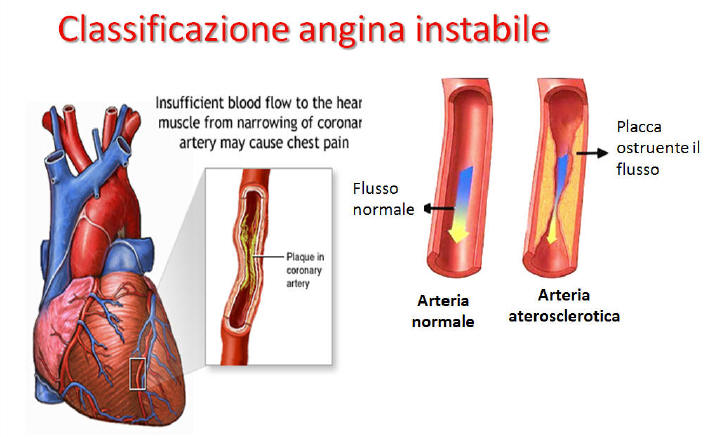 L'angina pectoris cause