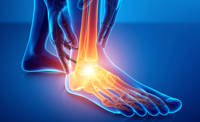 l'osteoartrite colpire piedi