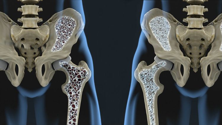 osteoporosi luca serra neurochirurgo